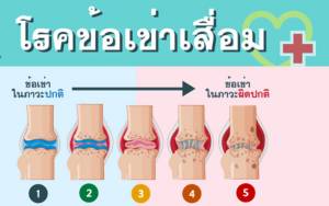 หญิงเสี่ยงข้อเข่าเสื่อมกว่าชาย 2-3 เท่า อายุ 40 ปีอัป ยิ่งเสี่ยง