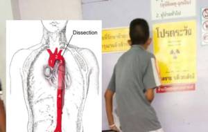 หมอยัน “หลอดเลือดแดงใหญ่โป่งพองแตกในช่องอก” พบน้อย ไม่มีอาการ มักพบในคนแก่