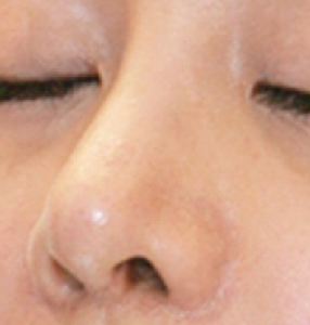 การผ่าตัดเสริมจมูกให้ปลอดภัยเป็นอย่างไร