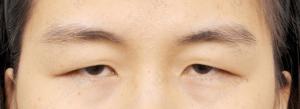 ภาวะเปลือกตาหย่อน