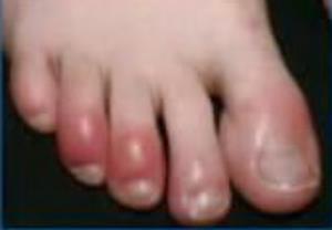 กรมควบคุมโรค ยังไม่ฟัน “นิิ้วเท้าบวมแดงม่วง” เป็นอาการโควิด แต่เตรียมเฝ้าระวัง