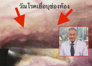 “หมอมนูญ” เผยเคสผู้ป่วยไข้เรื้อรังจาก “วัณโรคเยื่อบุช่องท้อง” เผยพบน้อยมาก-วินิจฉัยได้ยาก