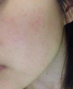ผื่นแดงที่หน้า (Red face Syndrome)