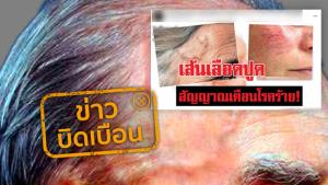 ข่าวบิดเบือน! เส้นเลือดปูดในร่างกาย คืออาการเตือนถึงโรคต่างๆ