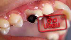 ข่าวปลอม! สาเหตุของการปวดฟัน ฟันผุเกิดจากแมงกินฟัน