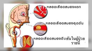 “หมอมนูญ” เผยโรคหลอดเลือดสมอง เป็นอันดับ 3 คร่าชีวิตคนไทย