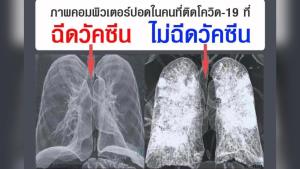หัวหน้าศูนย์ฉีดวัคซีนนานาชาติอินเดีย เผยภาพความแตกต่างของปอดผู้ป่วยโควิด ผู้ได้รับวัคซีน-ไม่ได้รับวัคซีน