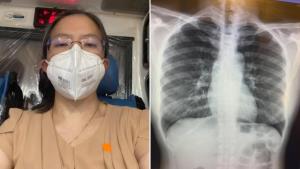 หมอรามาฯ แชร์ประสบการณ์ฉีด “ซิโนแวค” ครบ 2 เข็ม ภูมิคุ้มกันลดลง และติดเชื้อโควิด