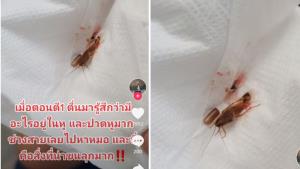 เตือนภัย! สาวปวดหูจนทนไม่ไหว หมอคีบเจอแมลงสาบยังไม่ตายเข้าไปวางไข่ในหู (ชมคลิป)