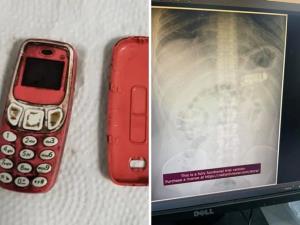 ทำไปเพื่อ! หนุ่มโคโซโวกลืนมือถือรุ่นตำนาน "โนเกีย 3310" ลงท้อง ต้องรุดผ่าตัดช่วยชีวิต