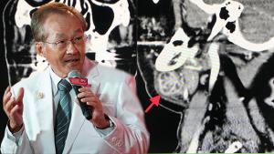 “หมอมนูญ” เจอผู้ป่วย “วัณโรคต่อมน้ำลาย” ชี้พบได้ไม่บ่อยแต่ควรระวัง