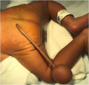 แพทย์บราซิลอึ้ง!ทารกน้อยเกิดมามีหางยาว12เซนติเมตรโผล่ตรงก้น