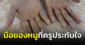 อาจารย์ประทับใจ! "มือนักเรียน" สัมภาษณ์เรียนพยาบาล สู้เพื่อครอบครัว ทั้งถลอกและรอยดำ