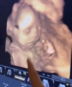 จมูกปังมาก “เจนนี่ รัชนก” เปิดภาพอัลตราซาวนด์ลูกสาวแบบจะ จะ หลังท้อง 6 เดือน