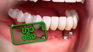 ข่าวจริง! สปสช.จัดซื้อรากฟันเทียม 7,000 ชุด สำหรับผู้ที่ไม่มีฟันทั้งปาก
