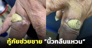 หวาดเสียว! กู้ภัยช่วยชาย "นิ้วกลืนแหวน" เนื้อล้อมแหวนจนมิด ใกล้ตัดนิ้วทิ้ง (ชมคลิป)