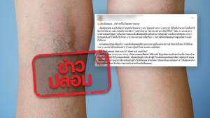 ข่าวปลอม! เส้นเลือดขอดเป็นสัญญาณเสี่ยงโรคหัวใจและเส้นเลือดตีบตัน