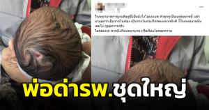พ่อโวย รพ.หลังพบศีรษะลูกมีบาดแผล ชาวเน็ตคาดเป็นโรคผิวหนัง "ภาวะไม่มีผิวหนังตั้งแต่เกิด"