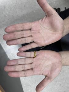 บอกลาเหงื่อออกมือ ปัญหากวนใจ