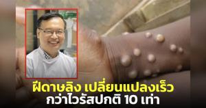 "นักไวรัสวิทยา" เผยผลวิเคราะห์ ระบุไวรัสฝีดาษลิงเปลี่ยนแปลงเร็วกว่าไวรัสปกติ 10 เท่า