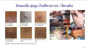 เปิดข้อแตกต่าง "ฝีดาษลิง" VS โรคขึ้นผื่นตุ่มอื่น