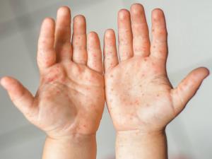 แนะสังเกตอาการ "มือ เท้า ปาก" รุนแรงในเด็กเล็ก ให้รีบพบแพทย์ทันที