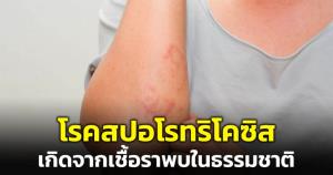 "หมอมนูญ" เผยเคสผู้ป่วยโรคสปอโรทริโคซิส เกิดจากเชื้อราพบในธรรมชาติ