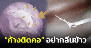 แพทย์หญิงเตือน! "ก้างปลาติดคอ" อย่ากลืนข้าวหวั่นทำก้างปักลึกขึ้น