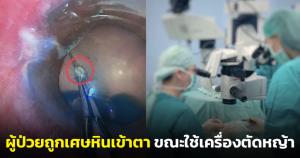 ภัยใกล้ตัว! “หมออารักษ์” เผยเคสผู้ป่วยถูกเศษหินกระเด็นฝังในเบ้าตา ขณะใช้เครื่องตัดหญ้า