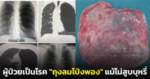 “หมอมนูญ” ยกเคสผู้ป่วยวัย 45 ปีเป็นโรค "ถุงลมโป่งพอง" ระบุไม่สูบบุหรี่ก็เป็นได้