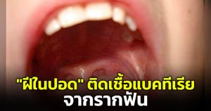 อันตราย! "หมอมนูญ" เจอเคสผู้ป่วย "ฝีในปอด" ติดเชื้อแบคทีเรียจากรากฟัน