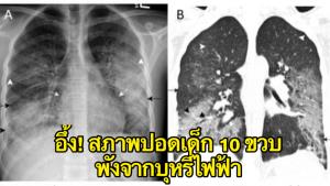 อึ้ง! เจอเด็ก 10 ขวบป่วยปอดอักเสบ มีสภาพเหมือนรังผึ้ง จากบุหรี่ไฟฟ้า