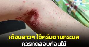 “หมอแล็บฯ” เตือนสาวๆ ใช้ครีมตามกระแส อย่าลืมทดสอบกับผิวก่อนใช้
