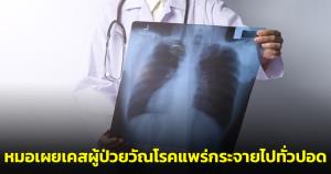 “หมอมนูญ” เผยเคสผู้ป่วยวัณโรคแพร่กระจายเข้ากระแสเลือดไปทั่วปอด หลังติดเชื้อโควิด-ได้ยาสเตียรอยด์