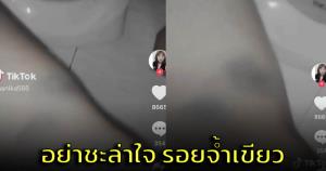 สาวแชร์ประสบการณ์ มีรอยจ้ำเขียวตามแขน-ขา สุดท้ายตรวจพบมะเร็งเม็ดเลือดขาว (ชมคลิป)