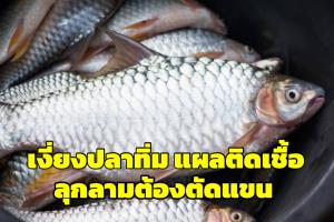 สยอง! ศัลยแพทย์เผยเคสคนไข้ชาย ถูกเงี่ยงปลาทิ่ม สุดท้ายต้องตัดแขน (ชมคลิป)