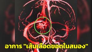 “หมออารักษ์” เผยเคสคนไข้ "เส้นเลือดขอดในสมอง" ชี้มักเจอในคนอายุน้อย ค่าใช้จ่ายสูง-รักษานาน