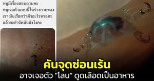 "หมอแล็บฯ" เผย คันจุดซ่อนเร้น ลองก้มดูอาจเจอตัว "โลน" ดูดเลือดเป็นอาหาร