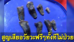 “หมอแล็บฯ” เผยเคสผู้ป่วยถูกตัดนิ้วมือ นิ้วเท้า แต่ตรวจละเอียดพบไม่เป็นโรคอะไรเลย จนสูญเสียอวัยวะฟรีๆ