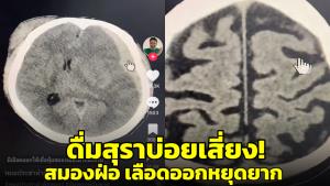 หมอสมองเตือน! ดื่มสุราบ่อย หากต้องรับการผ่าตัดเสี่ยงเลือดออกในสมอง และหยุดยาก