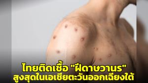 "หมอยง" เผยรายงานระบุยอดติดเชื้อ "ฝีดาษวานร" ในไทย สูงสุดในเอเชียตะวันออกเฉียงใต้