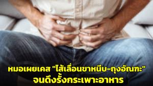 หมอเตือนภัย! เผยเคสคนไข้ป่วยไส้เลื่อนขาหนีบ-ถุงอัณฑะขนาดยักษ์ นาน 4 ปี จนดึงรั้งกระเพาะอาหาร