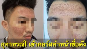 เห็นใจ! หนุ่มแชร์อุทาหรณ์หน้าพังหลังเข้าคอร์สทำหน้า "พิโคเลเซอร์" รู้ภายหลังคนทำไม่ใช่แพทย์