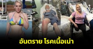 อุทาหรณ์! นางแบบสาวชาวอเมริกัน เกิดบาดแผลเล็กๆ ก่อนติดเชื้อลุกลามจนต้องตัดขา เผยไทยก็มีเชื้อตัวนี้