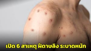 หมอยง เผย 6 สาเหตุ ที่ฝีดาษลิง ระบาดหนักในไทย พบผู้ป่วยเพิ่มขึ้นอย่างรวดเร็ว