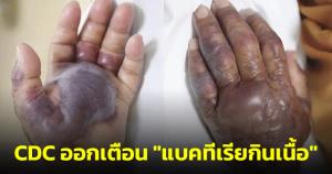 “หมอหมู” เผย CDC ออกเตือน "แบคทีเรียกินเนื้อ" ย้ำบางรายอาการรุนแรงถึงขั้นเสียชีวิต