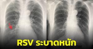 “หมอมนูญ” เผยเคสผู้สูงอายุติดเชื้อไวรัส RSV มีอาการหนัก เปรยอนาคตอาจมีวัคซีนป้องกัน