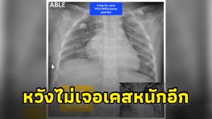 “หมอเด็ก” เตือนไวรัส “RSV” หลังรักษาผู้ป่วยนาน 9 วัน หวังไม่เจอเคสหนักเท่านี้อีก