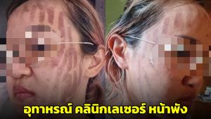 สาวเผยอุทาหรณ์! คลินิกความงามให้พนักงานใหม่เลเซอร์ ทำหน้าพัง แถมไม่รับผิดชอบ