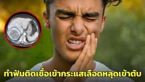 หมอเผยอุทาหรณ์! เคสคนไข้ไขมันพอกตับ ทำติดเชื้อง่าย หลังทำฟันเชื้อเข้ากระแสเลือดหลุดเข้าตับ